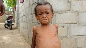 1000 طفل في لحج ضحايا الموت جوعاً وسوء التغذية ..«تفاصيل»