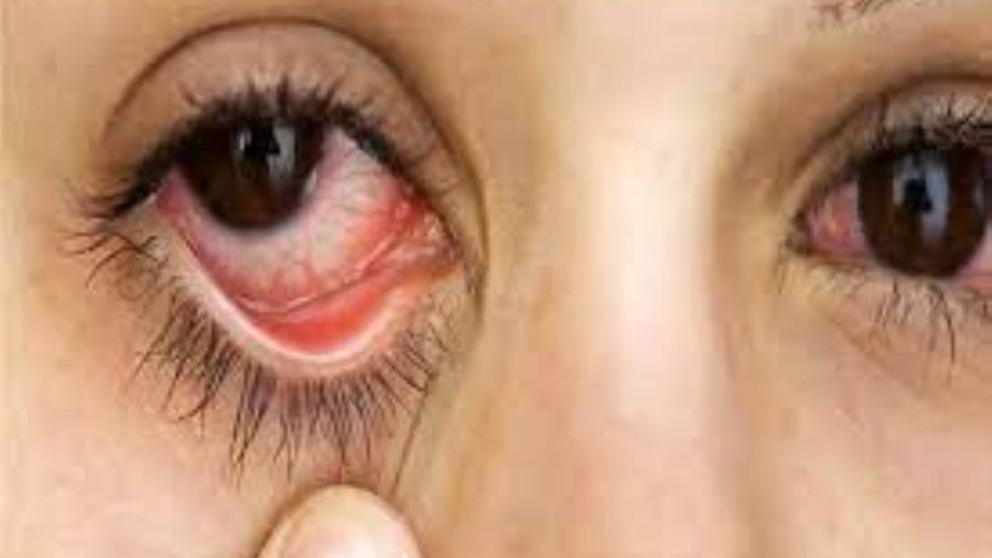 نصائح لمواجهة جفاف العين في سن اليأس. ما هي؟