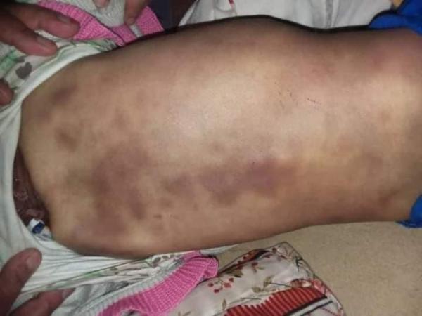 مقتل طفلة جراء التعذيب والضرب من قبل زوجة أبيها في صنعاء