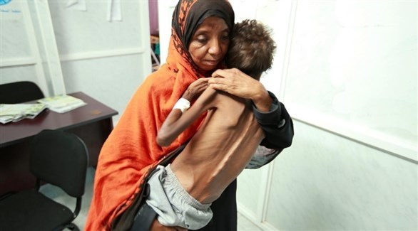 الأمم المتحدة: ارتفاع معدلات سوء التغذية الحاد بين الأطفال في اليمن